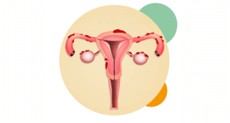 Endometriose Doen A Da Mulher Moderna Considerada A Maior Causa De Infertilidade Feminina